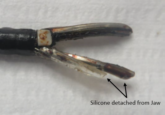 Example of a device experiencing silicone detachment. 