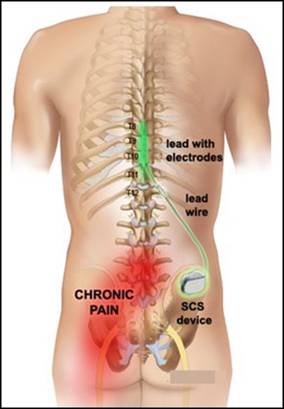 Abbott’s Spinal Cord Stimulation (SCS) System is an implantable device, called a neurostimulator, to treat long-term (chronic) pain of the torso, arms, and legs 