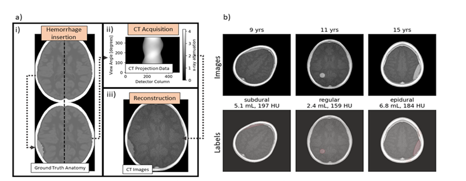 Synthetic intracranial hemorrhage (ICH) and CT imaging pipeline (a). Here an epidural hoemorrhage is inserted and expanded between the skull and the brain dura, compressing the adjacent brain and shifting the midline as demonstrated by the shift anatomy relative to the black dotted line a. i). The ground truth anatomy with ICH is virtually imaged using a CT simulation framework and reconstructed a. ii, a. iii). The resulting datasets produced by this pipeline are shown in b) as age-labeled CT images with an