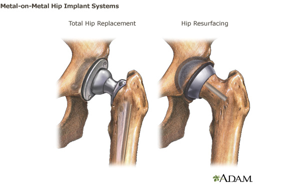 Hip Replacement  Procedure, Symptoms, Types of Implants and Risks